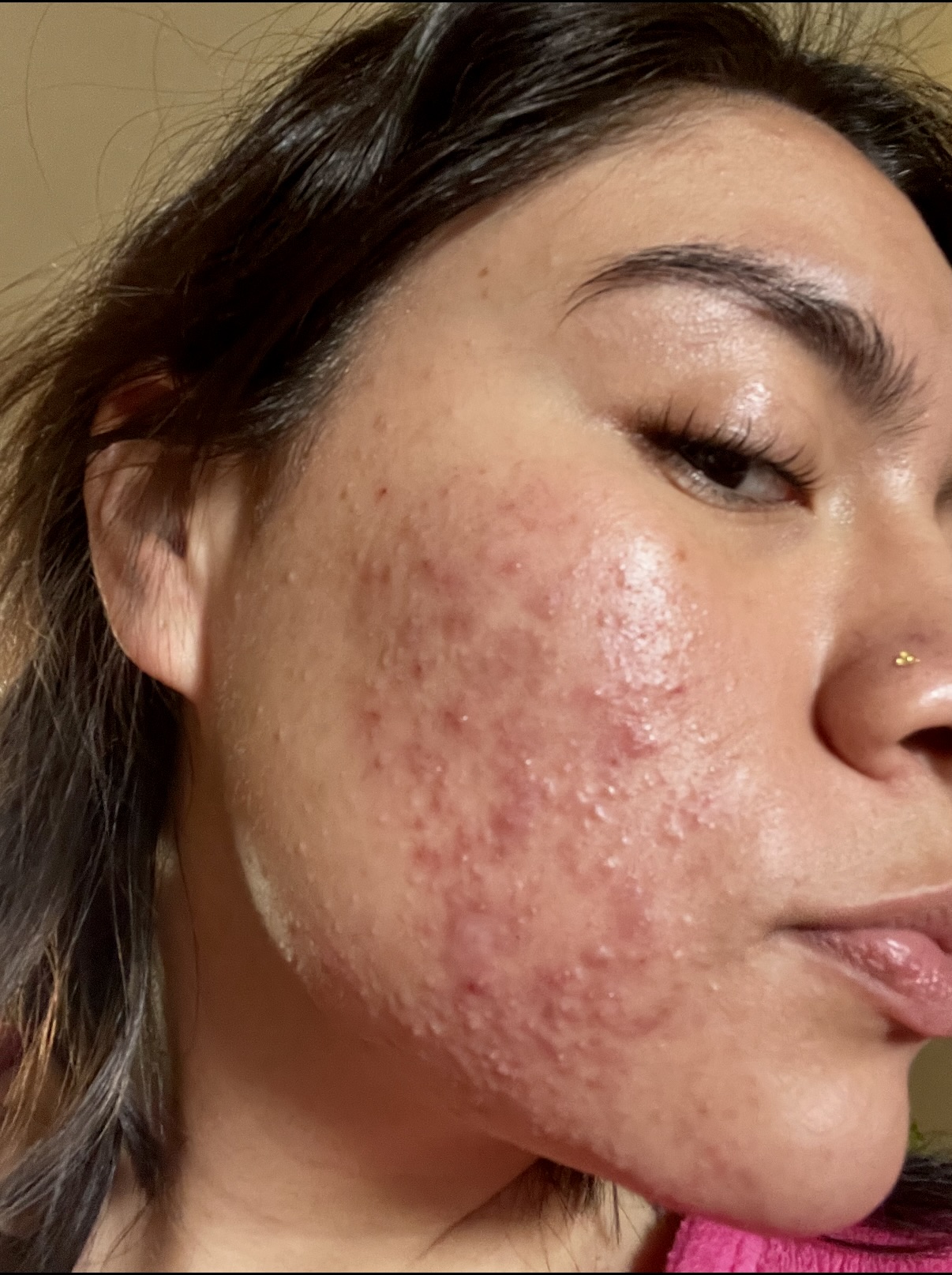 Before — acne skin